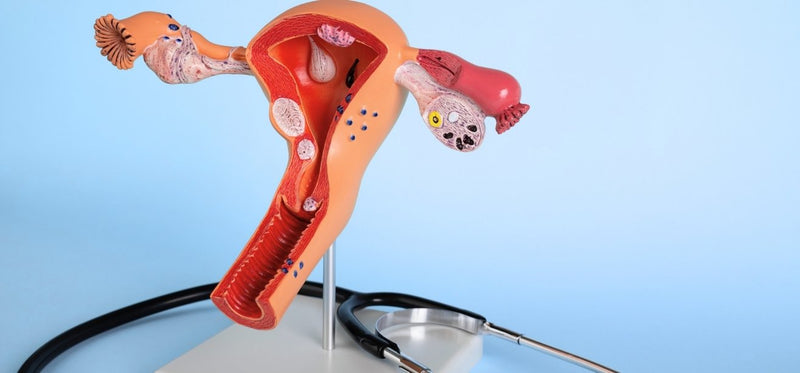 A medical model of the female reproductive system showing pelvic tissue pathologies, used to illustrate how endometriosis can impact surrounding pelvic organs.