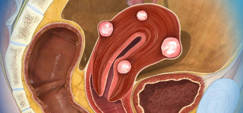 How to Naturally Reduce Fibroids at Home: Remedies & What to Know