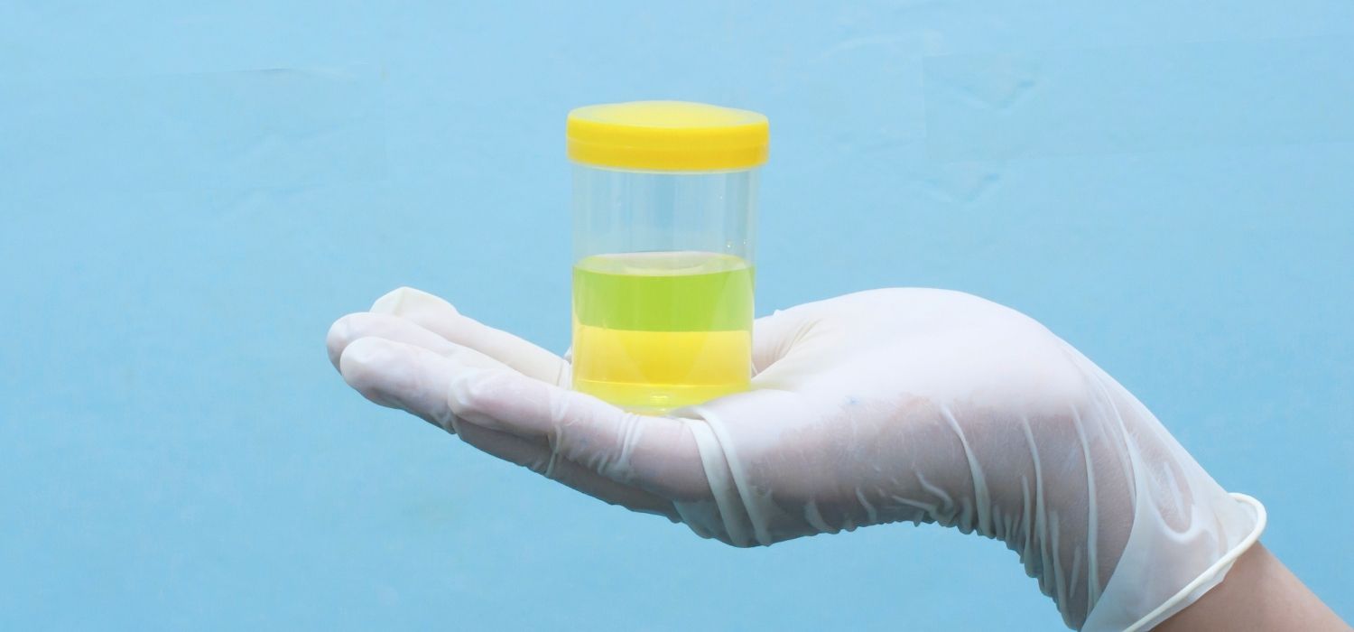 A gloved hand holding a urine sample cup against a blue background.