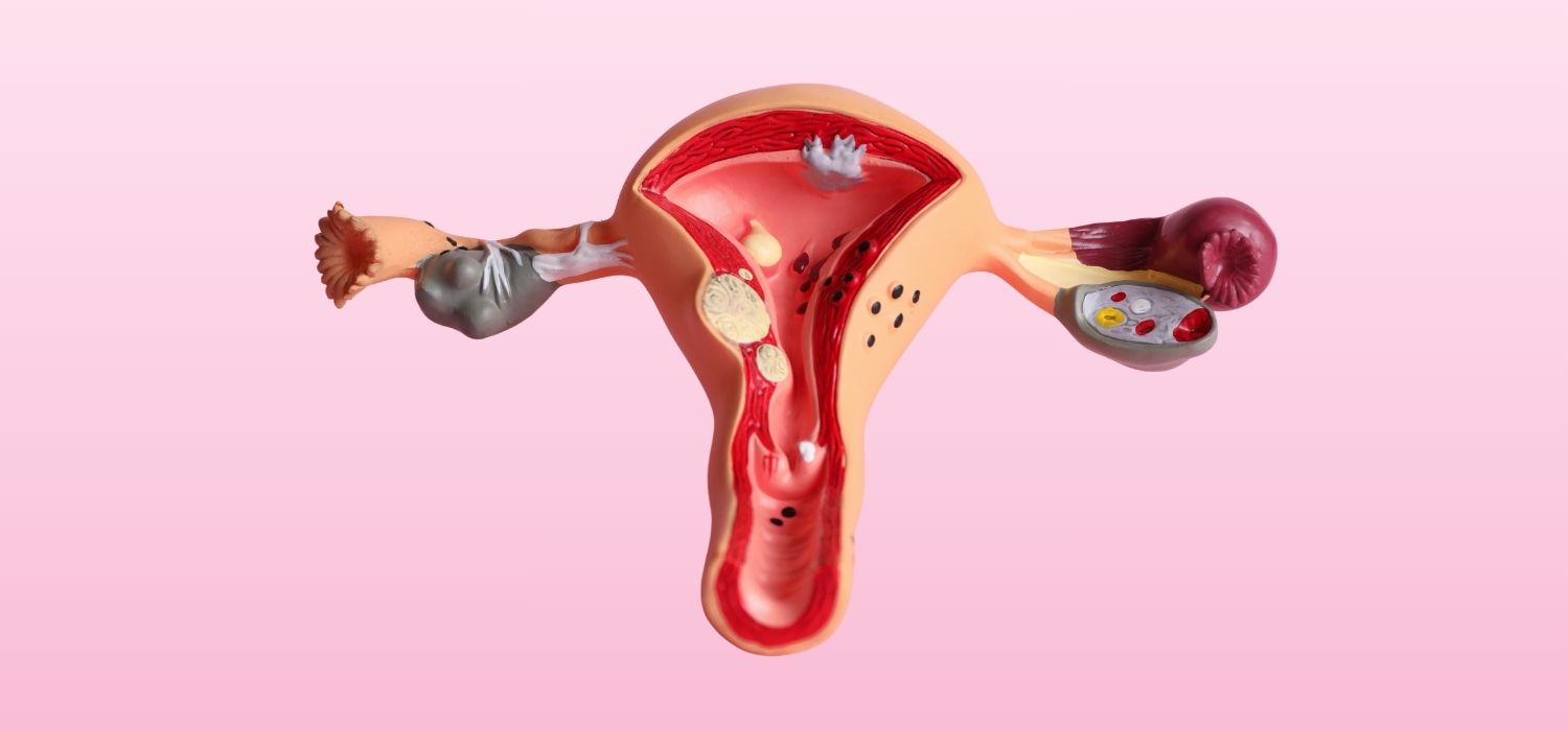 A medical cross-section model of the uterus and ovaries showing common conditions like cysts and fibroids, pictured on a pink background.