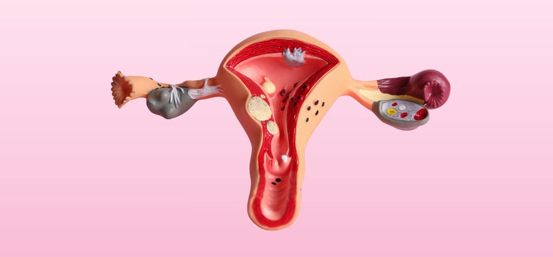 A medical cross-section model of the uterus and ovaries showing common conditions like cysts and fibroids, pictured on a pink background.