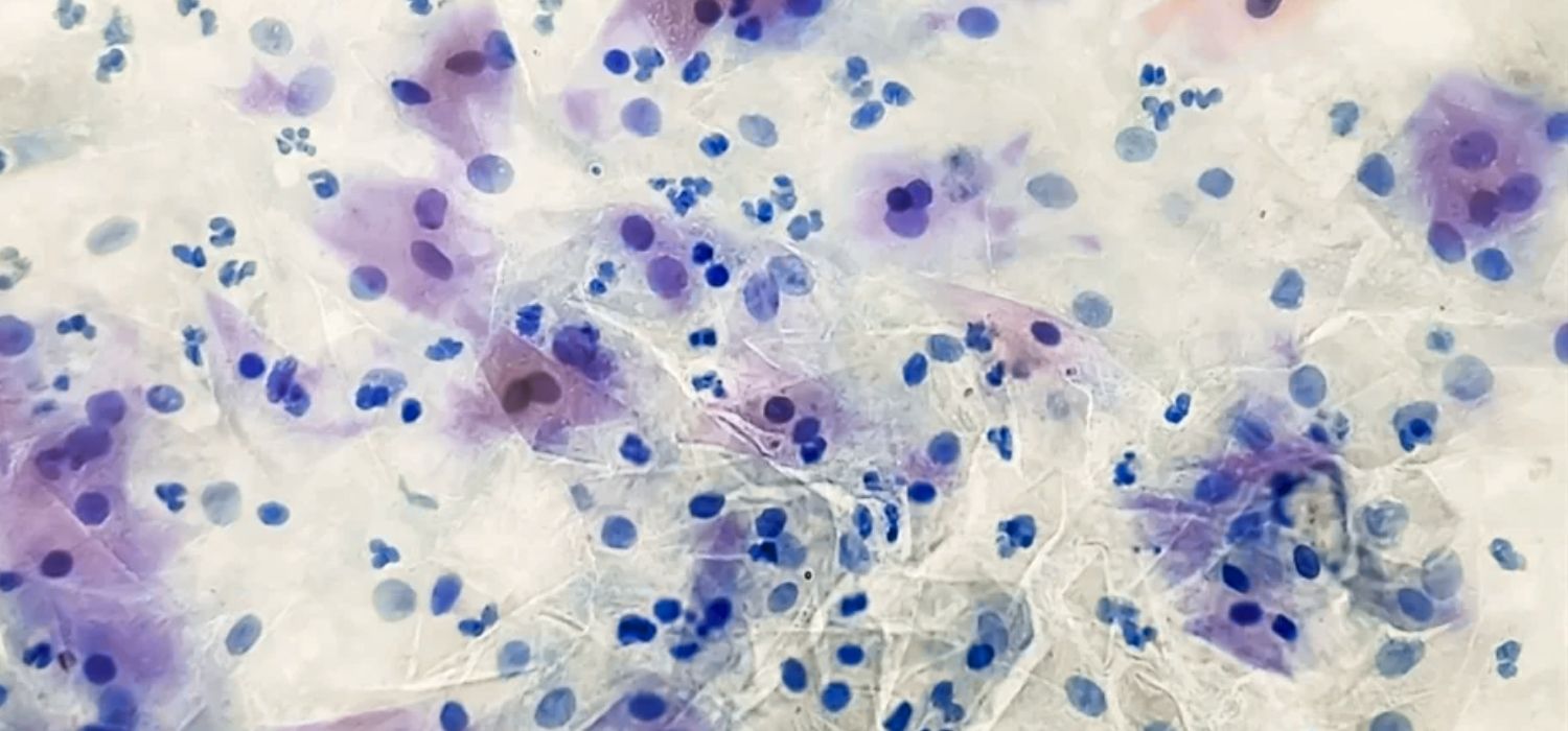 Is Gardnerella the Same as Gonorrhea?